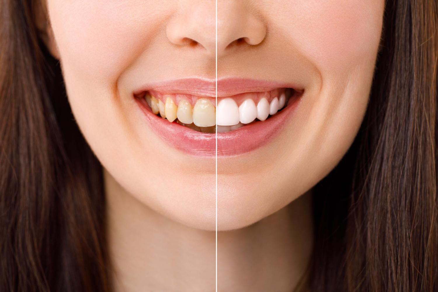 Teeth Whitening: What Works and What to Avoid